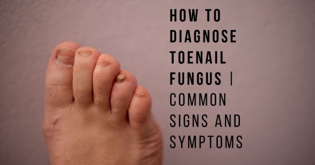 14 Toe nail Fungus: Symptoms, Causes, Treatment & Prevention The Complete Guide 3 Common Symptoms of Nail Fungus