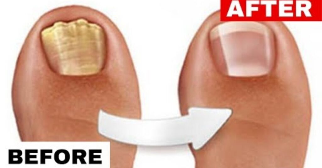 14 Toe nail Fungus: Symptoms, Causes, Treatment & Prevention The Complete Guide 2 What Does Early Toenail Fungus Look Like?